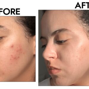 Face Reality—a Referral-Only Skincare Brand—Drastically Improved My Acne